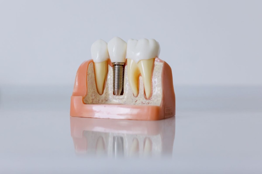 Implant dentar la EbiDent, Sector 3 București